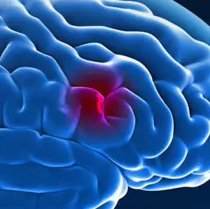 Ile żyje człowiek po udarze? Statystyki i czynniki przeżywalności