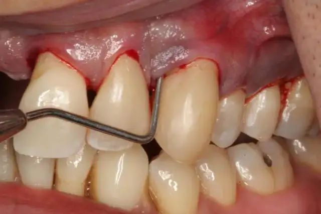 Rak dziąseł objawy: Jak rozpoznać niepokojące symptomy i chronić zdrowie