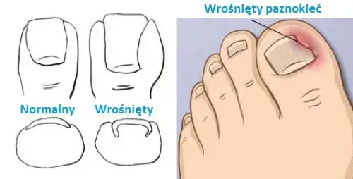 Jak skutecznie leczyć wrastający paznokieć - domowe sposoby i maści