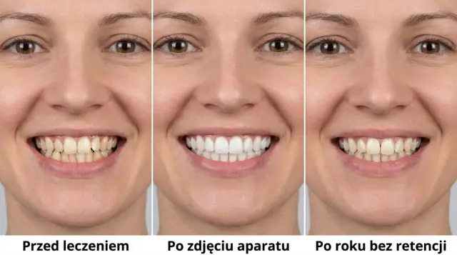 Uśmiech kobiety przed leczeniem, po zdjęciu aparatu i po roku bez retencji. Widać różnicę w prostowaniu zębów i utrzymaniu efektu.