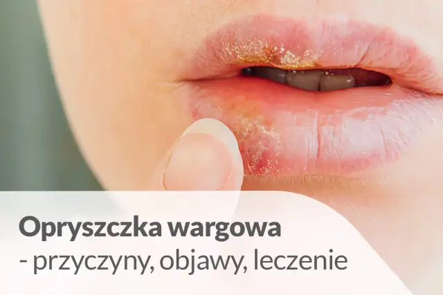 Zbliżenie na usta z widoczną opryszczką wargową. Dowiedz się, ile trwa opryszczka na ustach i jak ją leczyć.
