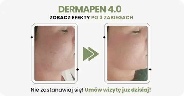 Dermapen 4.0: zobacz efekty po 3 zabiegach. Skóra przed i po, widoczna poprawa. Nie czekaj, umów wizytę!