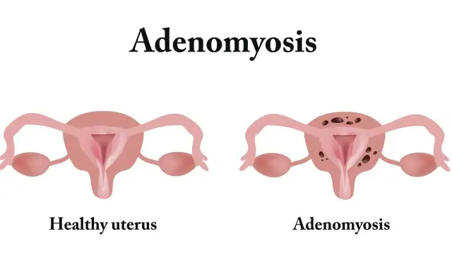 Porównanie zdrowej macicy z macicą dotkniętą **adenomiozą**, gdzie widoczne są zmiany w tkance.
