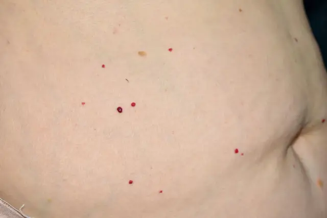 Skóra z licznymi czerwonymi pieprzykami i kilkoma brązowymi znamionami.