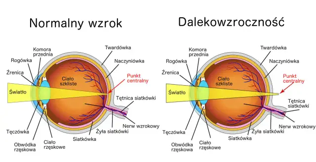 Porównanie oka z prawidłowym widzeniem i oka z nadwzrocznością. Promienie światła skupiają się za siatkówką.