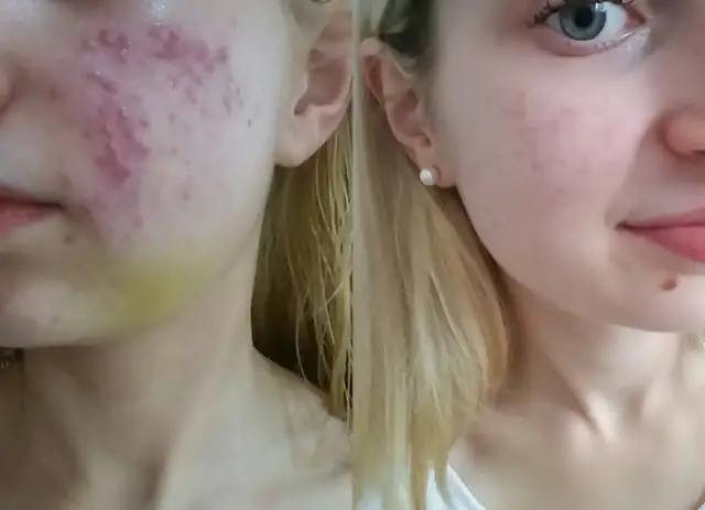 Przed i po kuracji trądziku. Zmiana skóry po zastosowaniu leczenia. Warto sprawdzić izotek cena.