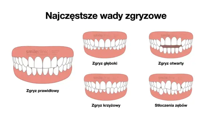 Prawidłowy zgryz - czy to tylko wygląd? Poznaj fakty i leczenie
