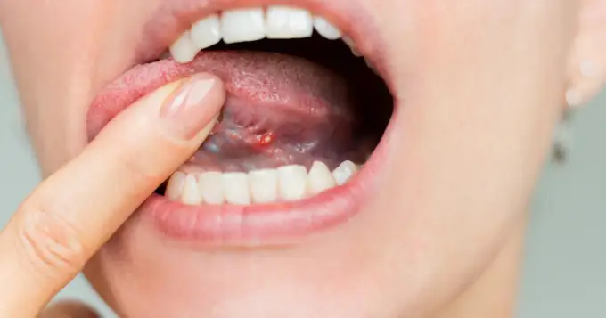 Ból i obrzęk pod językiem - Kiedy do dentysty?