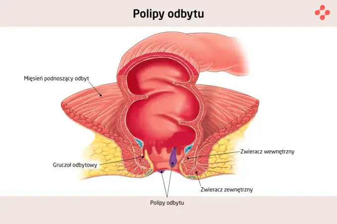 Polip to nowotwór? Kiedy jest łagodny, a kiedy przedrakowy