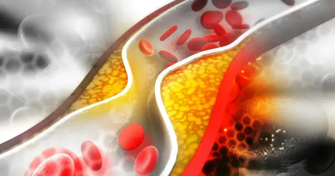 Tulip (atorwastatyna) - Jak stosować lek na cholesterol?