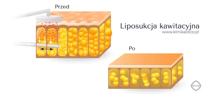 Liposukcja kawitacyjna - jak działa i kiedy ma sens?