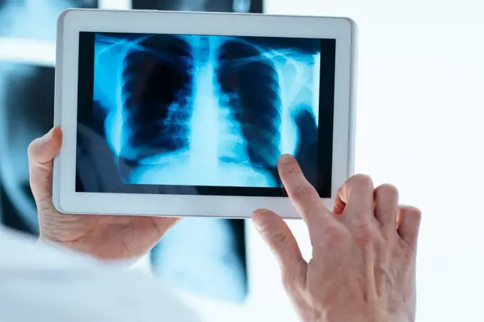 Sarkoidoza - objawy, leczenie, diagnostyka. Kiedy leczyć?