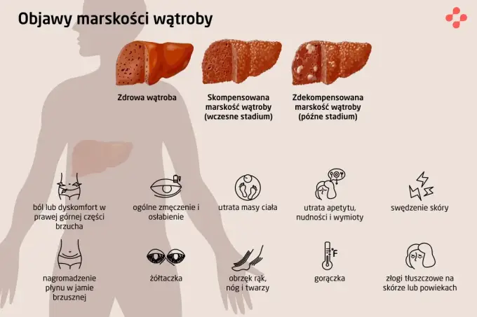 Marskość wątroby - objawy, przyczyny, leczenie. Sprawdź, co musisz wiedzieć!