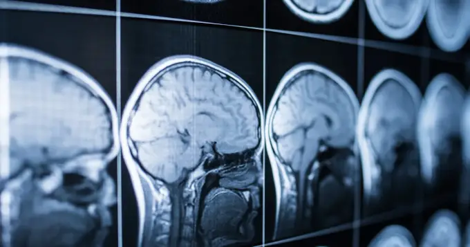 Śmierć mózgu - Diagnoza i skutki. Rozwiej wątpliwości