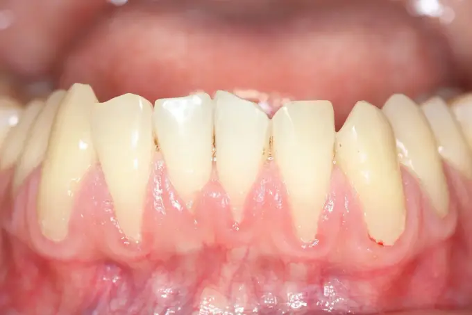 Białe dziąsła - Kiedy to grzybica, a kiedy leukoplakia?