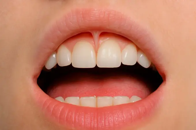 Przekłucie wędzidełka - Wszystko, co musisz wiedzieć o smiley i tongue web