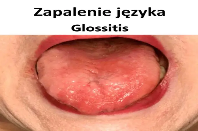 Zapalenie języka - Leki bez recepty i kiedy do lekarza?