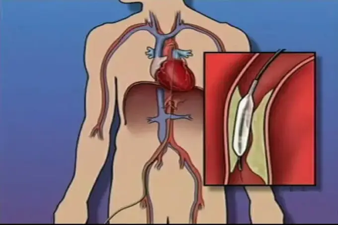 Angioplastyka i stent: Jak utrzymać drożność tętnic?