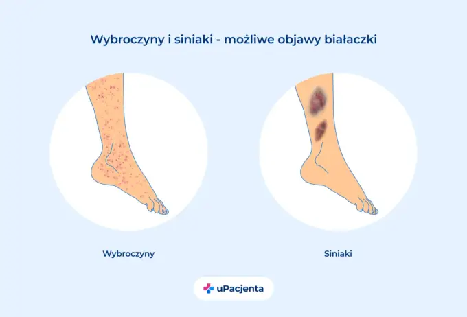 Ostra białaczka szpikowa - objawy, rozpoznanie i leczenie