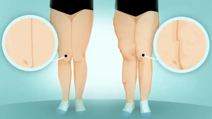 Lipodemia test - Czy istnieje jeden? Prawda o diagnozie
