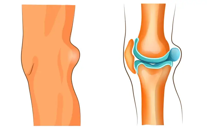 Knie mit Bakerzyste, die eine Schwellung hinter dem Kniegelenk zeigt. Die rechte Seite illustriert das Kniegelenk und die mögliche Bakerzyste, die eine Behandlung erfordert.