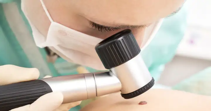 Lekarz bada pieprzyk dermatoskopem. Czy usuwanie pieprzyka boli? Zależy od metody i znieczulenia.