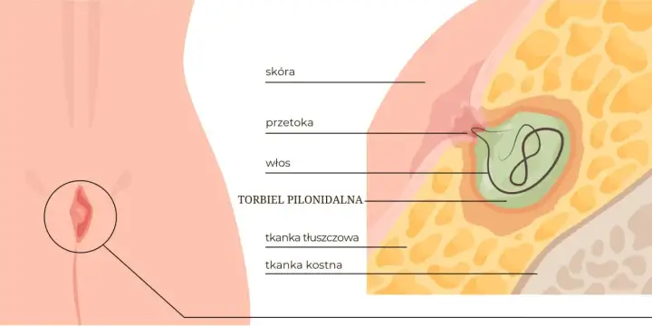 Przekrój skóry ukazujący torbiel pilonidalną z włosiem w środku, otoczoną tkanką tłuszczową i kostną.