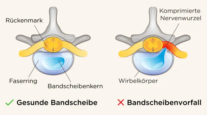Vergleich einer gesunden Bandscheibe mit einem Bandscheibenvorfall, der eine Nervenwurzel komprimiert und so Symptome verursacht.