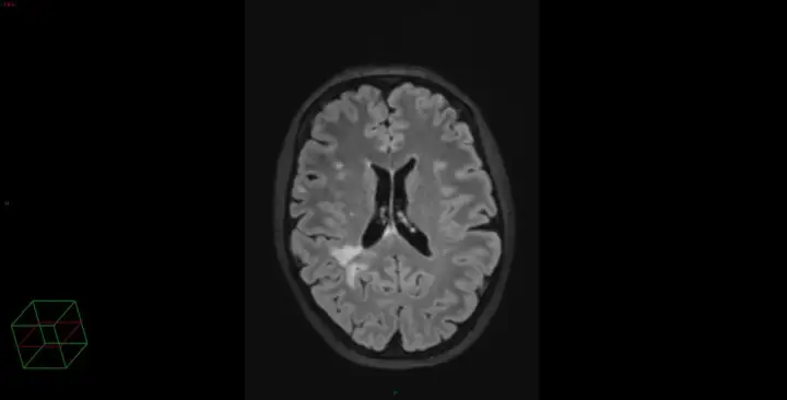IRM cérébrale montrant des hypersignaux de la substance blanche, potentiellement liés au stress chronique ou à d'autres facteurs vasculaires.