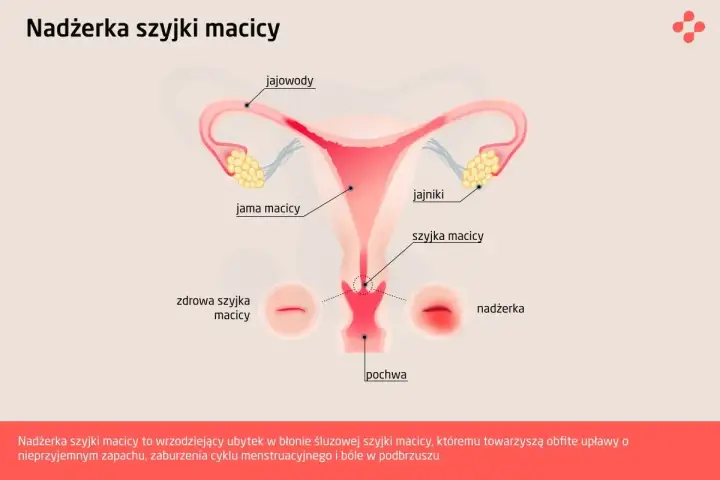 Ilustracja przedstawia anatomię kobiecych narządów rozrodczych z zaznaczoną nadżerką szyjki macicy, która jest wrzodziejącym ubytkiem.