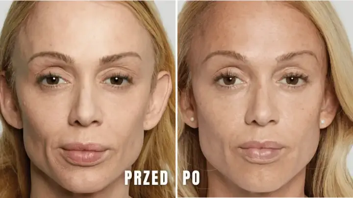 Przed i po zabiegu: skóra pod oczami wygładzona, zmarszczki zredukowane dzięki kwasowi polimlekowemu.