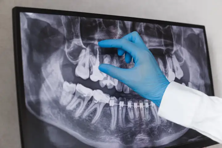 Dentysta w niebieskiej rękawiczce wskazuje na zdjęcie RTG zębów, analizując sytuację przed powtórnym leczeniem kanałowym.