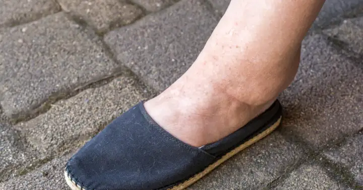 Obrzęk kostki, jeden z objawów marskości nerki, widoczny na nodze w czarnym bucie na tle kostki brukowej.