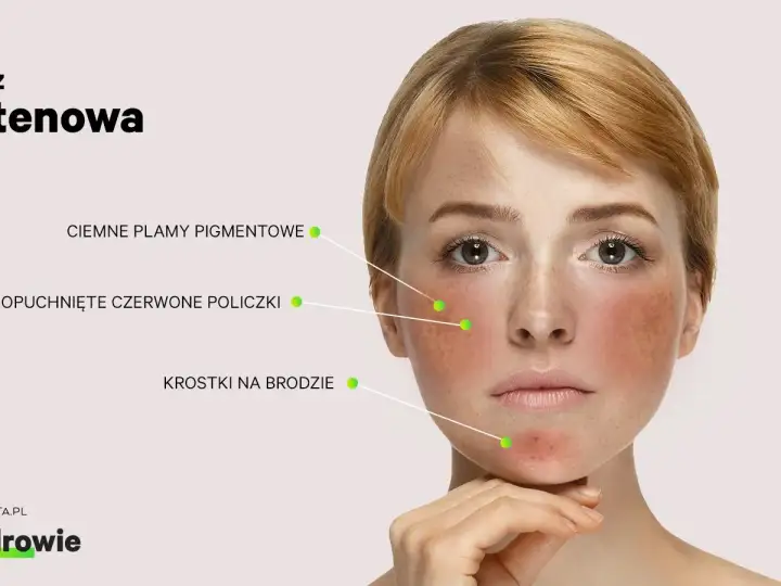 Gluten na twarzy? Wysypka, zajady - co oznaczają?