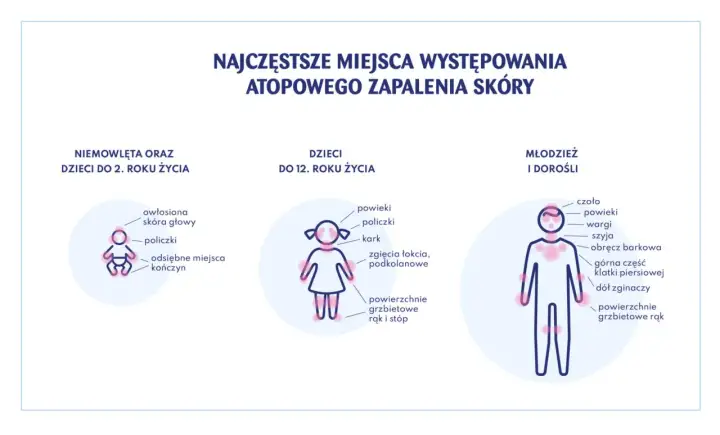 AZS u dzieci - jak pielęgnować skórę i zmniejszyć świąd