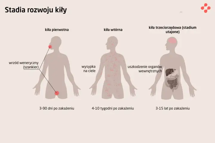 Kiła - objawy, diagnoza, leczenie. Kiedy nie czekać?
