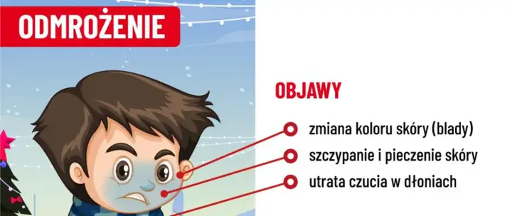 Chłopiec z bladą skórą i zmarzniętymi dłońmi, objawy odmrożenia: bladość, pieczenie, utrata czucia.
