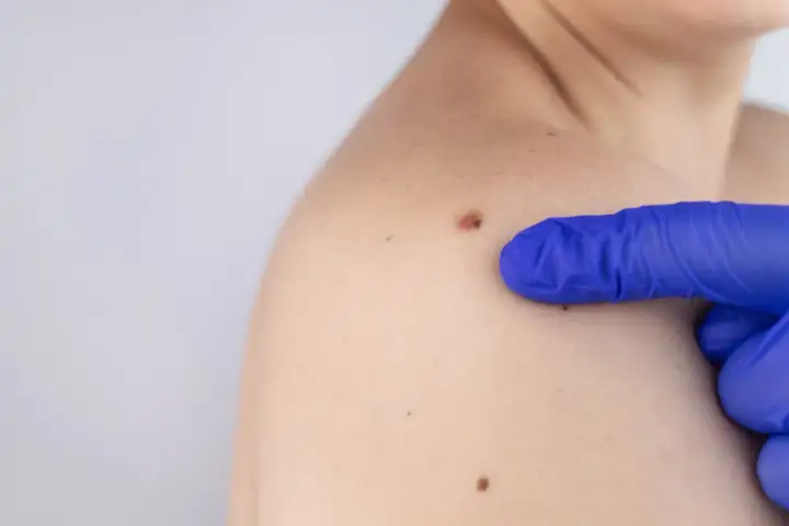 Dużo pieprzyków - Kiedy to norma, a kiedy do dermatologa?