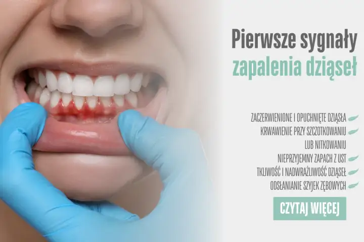 Zaczerwienione, opuchnięte dziąsła i krwawienie to pierwsze sygnały zapalenia dziąseł. Dowiedz się więcej.