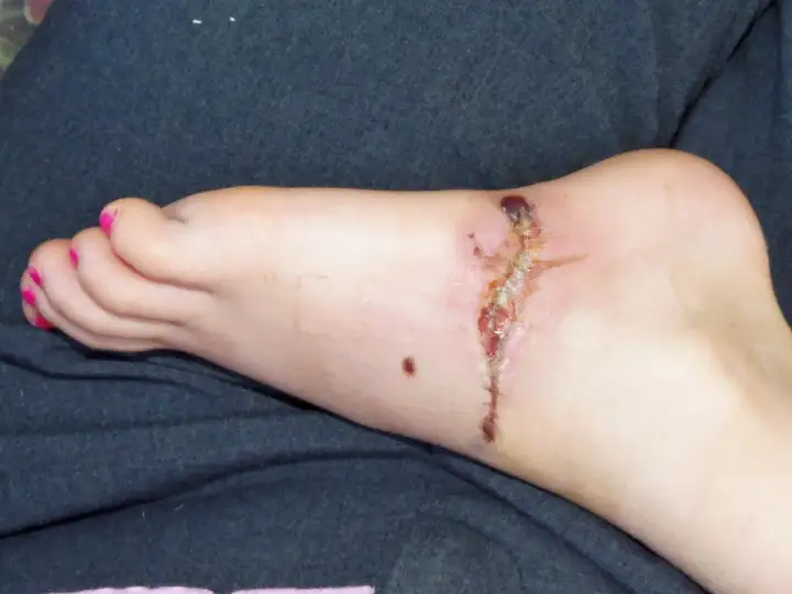 Stopa z raną pooperacyjną, która zaczyna wykazywać objawy gangreny. Widoczne są ciemne, martwicze tkanki.