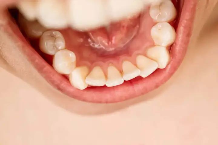 Il tartaro fa cadere i denti? Verità e prevenzione