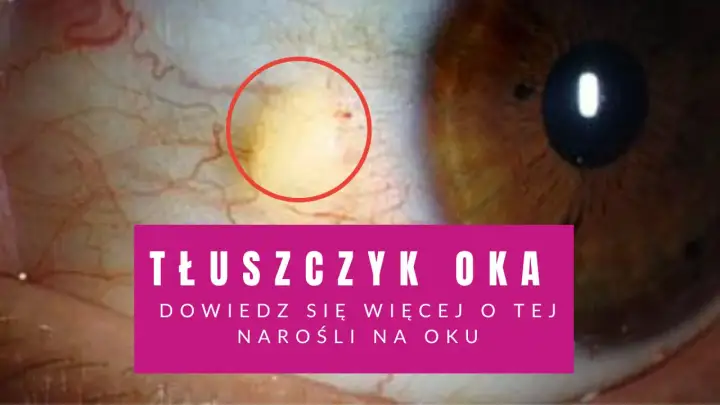 Żółtawy tłuszczyk na oku, widoczny w czerwonym okręgu, to niegroźna narośl. Dowiedz się więcej o tym zjawisku.
