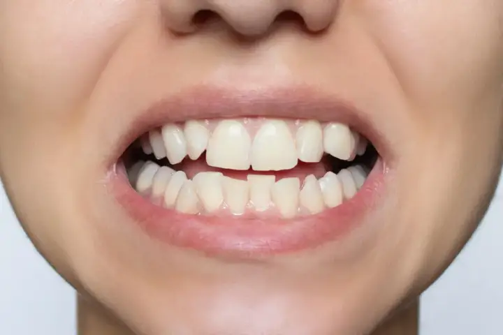 Malocclusione - Scegli il rimedio giusto per un sorriso stabile