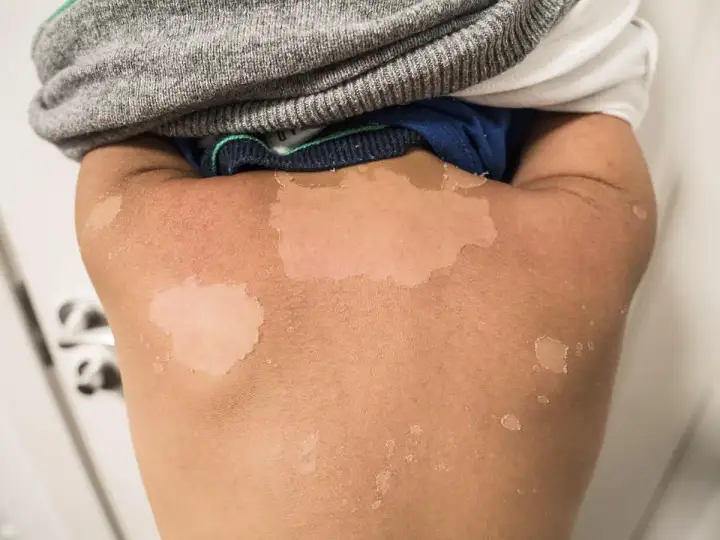 Schodzi skóra po opalaniu? Co robić i czego unikać!