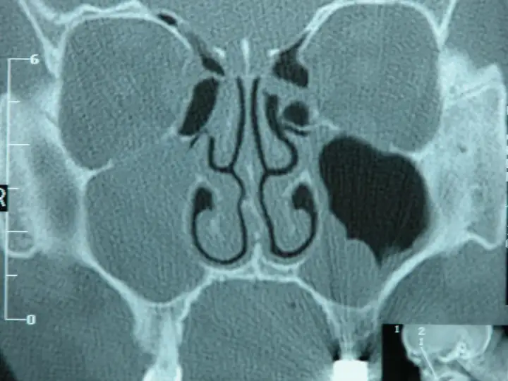 Torbiel czy rak zatoki szczękowej? Kluczowe różnice i objawy