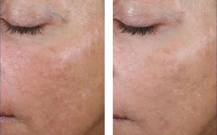Rétinol ou Acide Hyaluronique - Lequel choisir pour votre peau ?