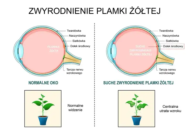 Porównanie normalnego oka z suchym zwyrodnieniem plamki żółtej. Obraz ukazuje, jak odbudowa plamki żółtej jest kluczowa dla normalnego widzenia.