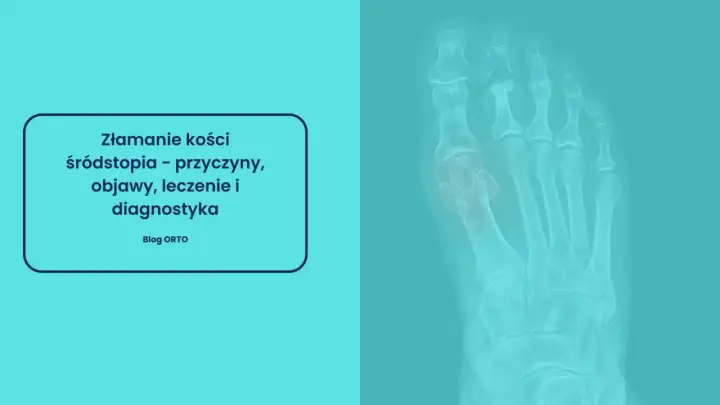 Złamanie kości śródstopia - objawy, leczenie, powrót do formy