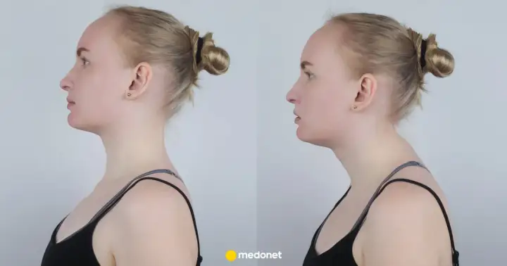 Garb na plecach - Kiedy to problem i jak sobie pomóc?