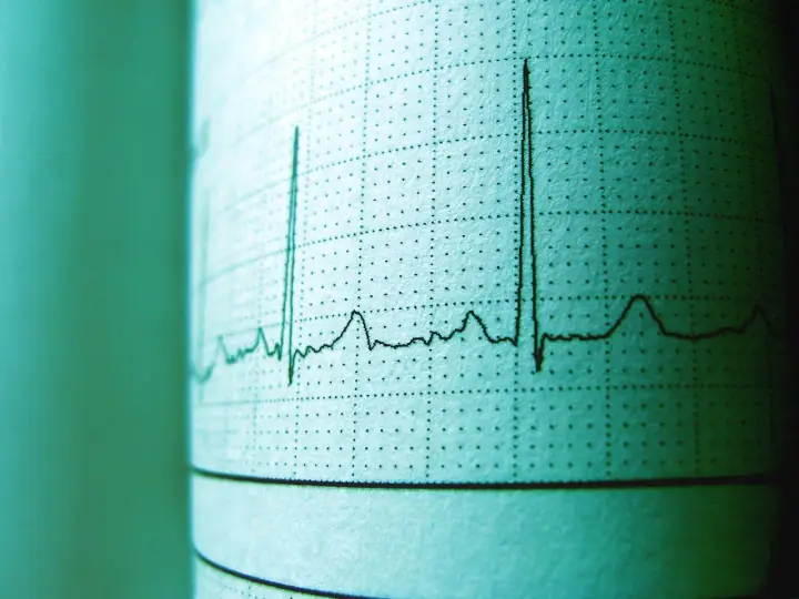 EKG z tętnem 94. Czy to norma? Wykres pokazuje rytm serca, a wynik 94 uderzeń na minutę jest w granicach normy dla dorosłych.